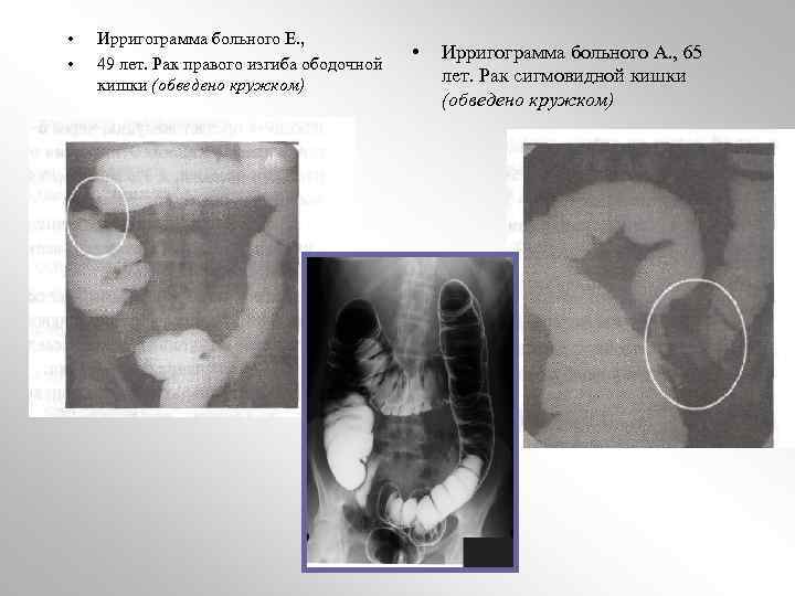 • • Ирригограмма больного Е. , 49 лет. Рак правого изгиба ободочной кишки