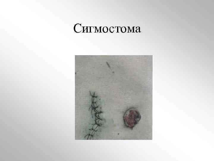 Сигмостома 