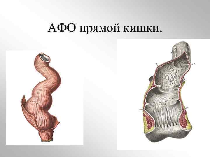 АФО прямой кишки. 