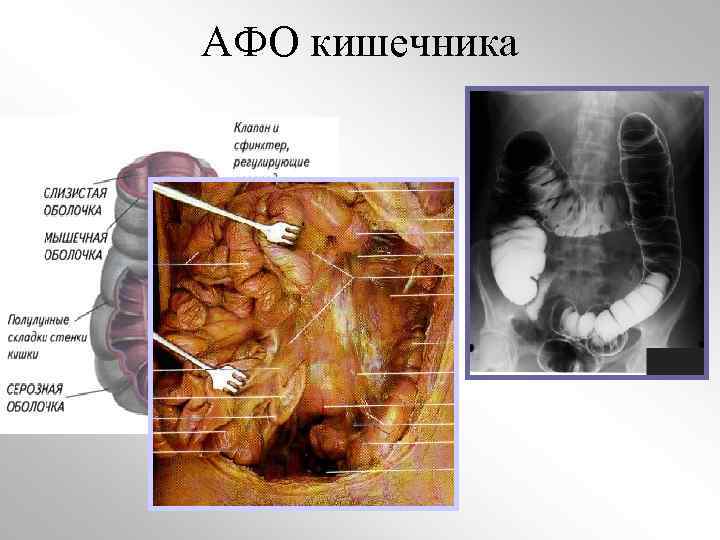 АФО кишечника 