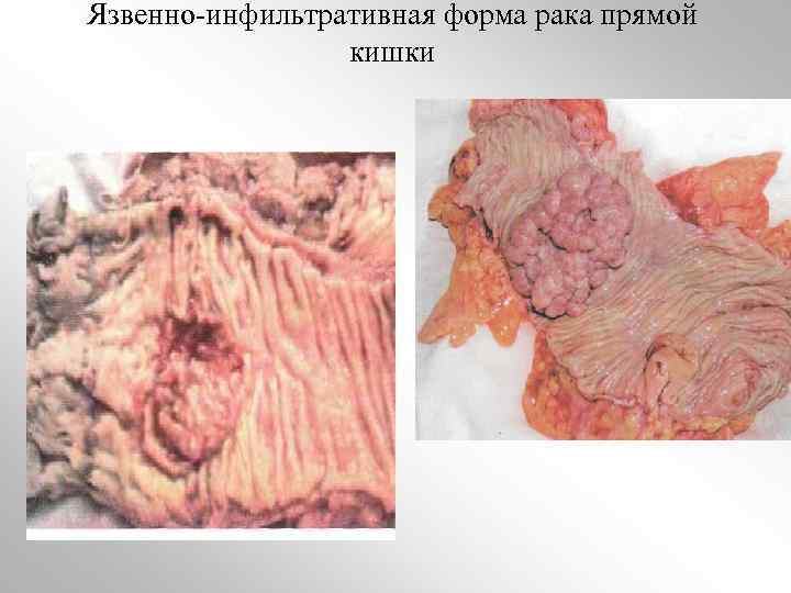 Язвенно-инфильтративная форма рака прямой кишки 