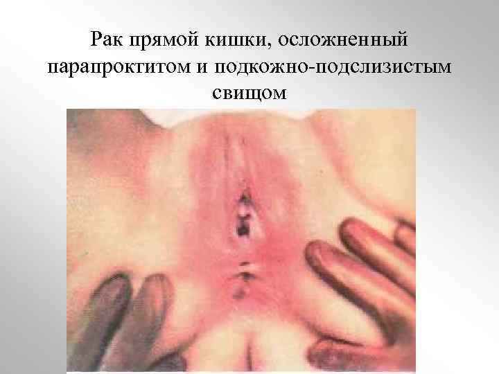 Рак прямой кишки, осложненный парапроктитом и подкожно-подслизистым свищом 