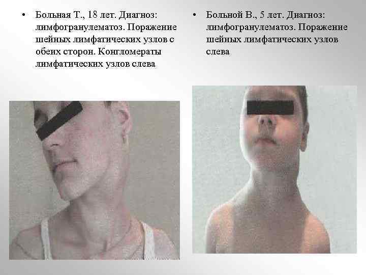  • Больная Т. , 18 лет. Диагноз: лимфогранулематоз. Поражение шейных лимфатических узлов с