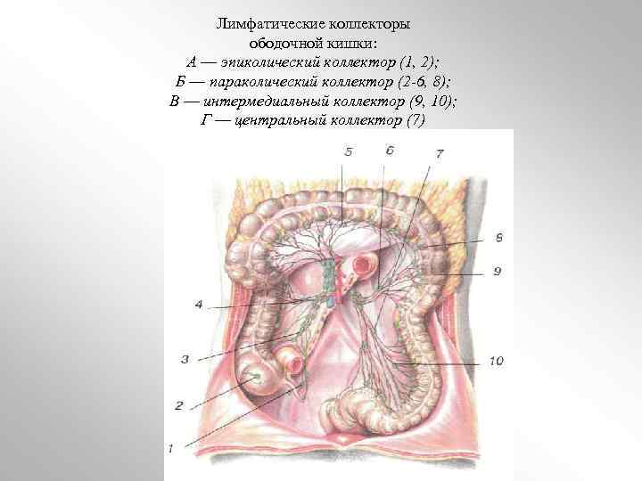 Лимфатические коллекторы ободочной кишки: А — эпиколический коллектор (1, 2); Б — параколический коллектор
