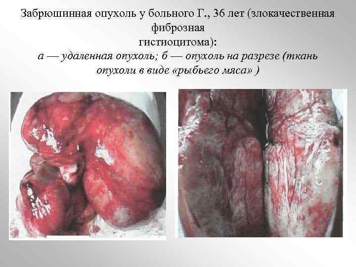 Забрюшинная опухоль у больного Г. , 36 лет (злокачественная фиброзная гистиоцитома): a — удаленная
