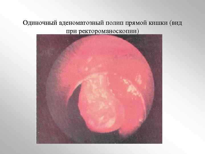 Одиночный аденоматозный полип прямой кишки (вид при ректороманоскопии) 