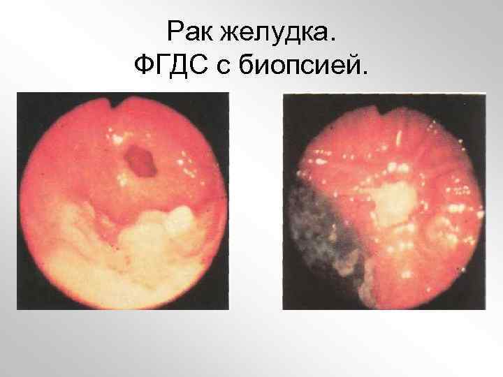Рак желудка. ФГДС с биопсией. 