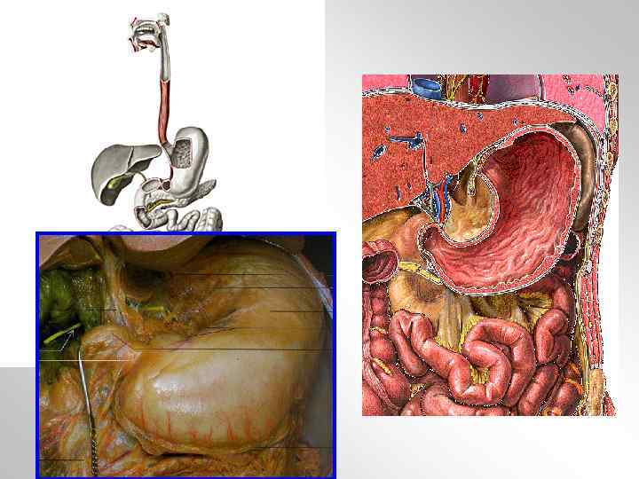 Прорастание опухоли желудка в поджелудочную железу