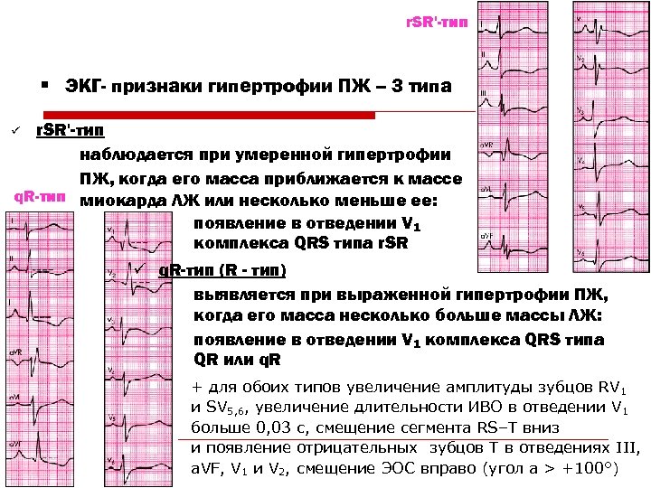 r. SR'-тип § ЭКГ- признаки гипертрофии ПЖ – 3 типа r. SR'-тип наблюдается при