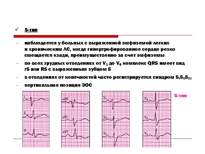 ü S-тип − наблюдается у больных с выраженной эмфиземой легких и хроническим ЛС, когда