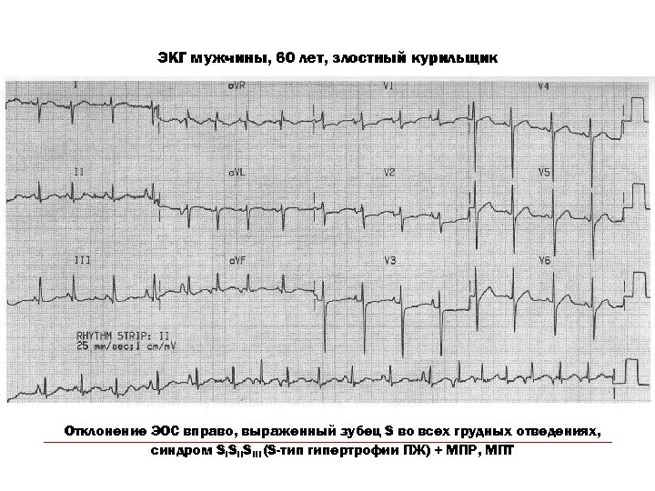 ЭКГ мужчины, 60 лет, злостный курильщик Отклонение ЭОС вправо, выраженный зубец S во всех