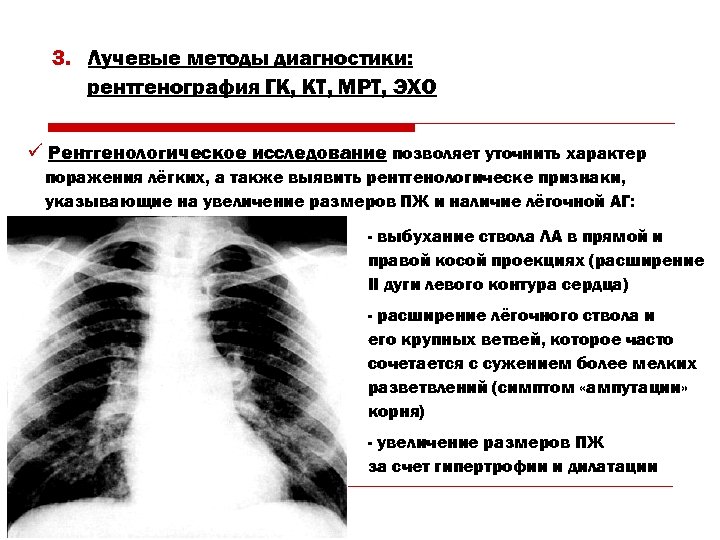 3. Лучевые методы диагностики: рентгенография ГК, КТ, МРТ, ЭХО ü Рентгенологическое исследование позволяет уточнить