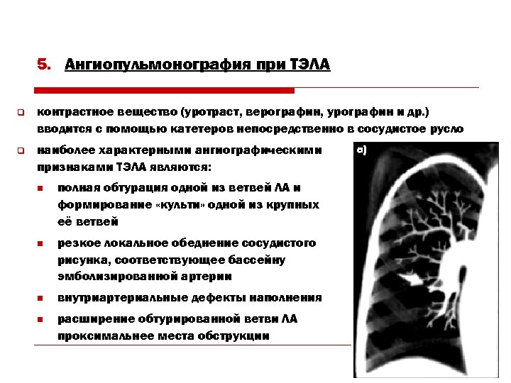 5. Ангиопульмонография при ТЭЛА q контрастное вещество (уротраст, верографин, урографин и др. ) вводится