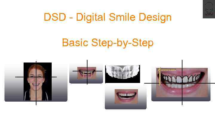 DSD - Digital Smile Design Basic Step-by-Step 