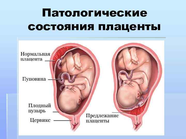 Патологические состояния плаценты 