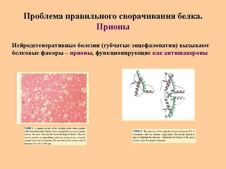 Проблема правильного сворачивания белка. Прионы Нейродегенеративные болезни (губчатые энцефалопатии) вызывают белковые факоры – прионы,
