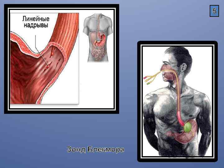 5 Зонд Блекмора 
