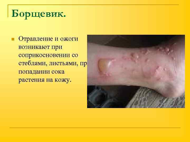 Борщевик. n Отравление и ожоги возникают при соприкосновении со стеблями, листьями, при попадании сока