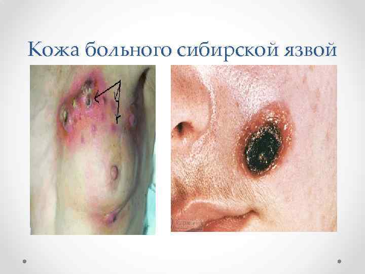 Кожа больного сибирской язвой 