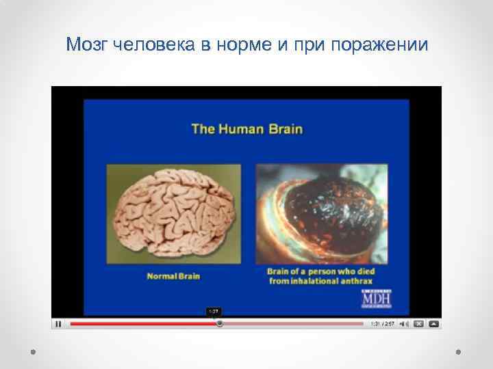Мозг человека в норме и при поражении 