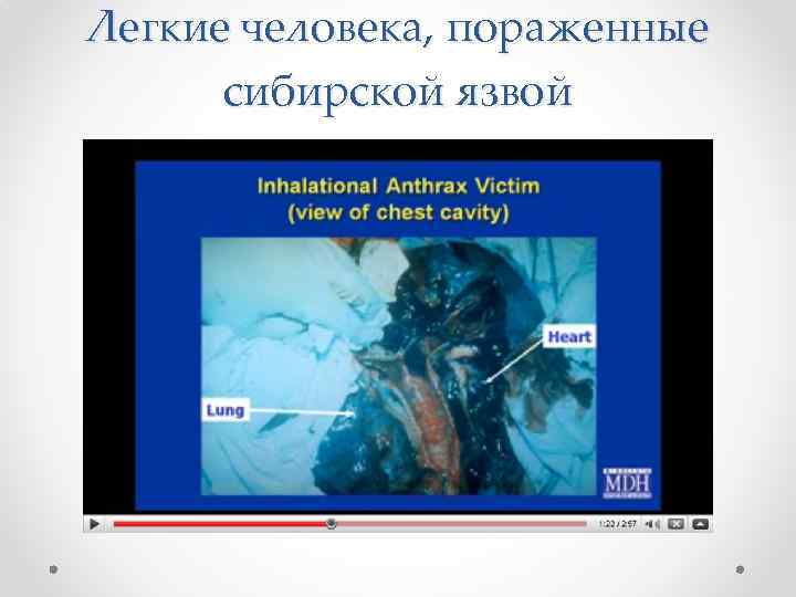 Легкие человека, пораженные сибирской язвой 