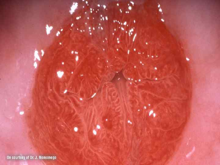 Крупный эктропион, стык эпителиев 