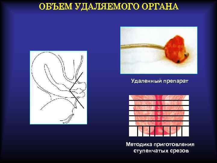 ОБЪЕМ УДАЛЯЕМОГО ОРГАНА Удаленный препарат Методика приготовления ступенчатых срезов 