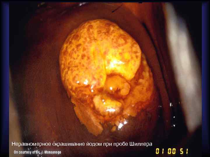 Неравномерное окрашивание йодом при пробе Шиллера 