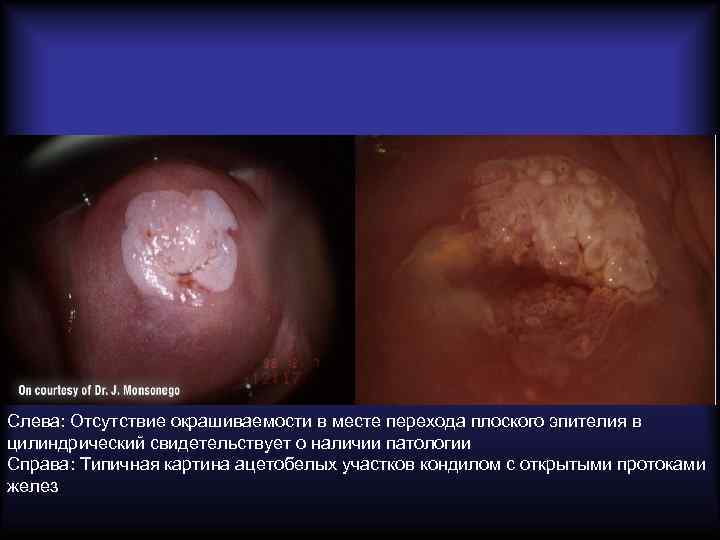 Слева: Отсутствие окрашиваемости в месте перехода плоского эпителия в цилиндрический свидетельствует о наличии патологии
