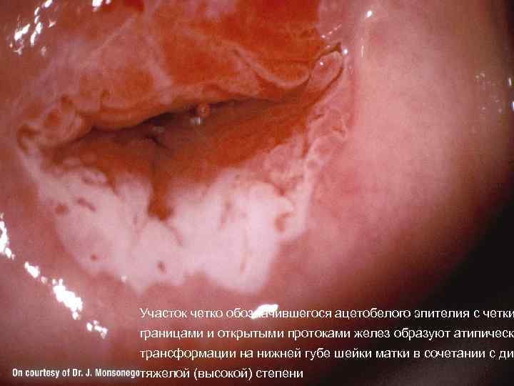 Участок четко обозначившегося ацетобелого эпителия с четки границами и открытыми протоками желез образуют атипическ