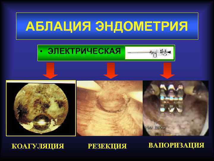АБЛАЦИЯ ЭНДОМЕТРИЯ • ЭЛЕКТРИЧЕСКАЯ КОАГУЛЯЦИЯ РЕЗЕКЦИЯ ВАПОРИЗАЦИЯ 