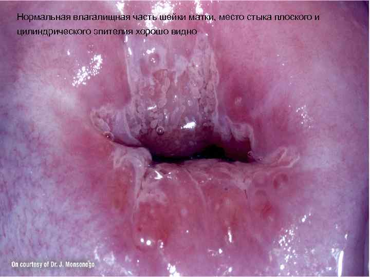 Нормальная влагалищная часть шейки матки, место стыка плоского и цилиндрического эпителия хорошо видно 