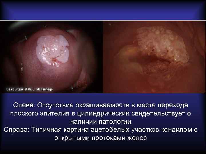 Слева: Отсутствие окрашиваемости в месте перехода плоского эпителия в цилиндрический свидетельствует о наличии патологии