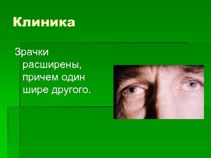 Клиника Зрачки расширены, причем один шире другого. 