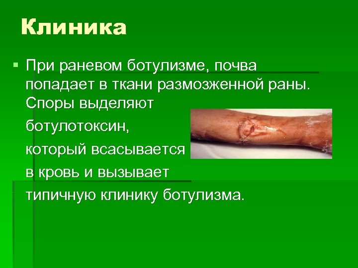 Клиника § При раневом ботулизме, почва попадает в ткани размозженной раны. Споры выделяют ботулотоксин,