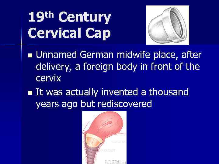 19 th Century Cervical Cap Unnamed German midwife place, after delivery, a foreign body