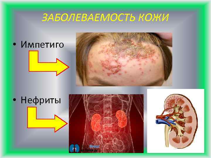 ЗАБОЛЕВАЕМОСТЬ КОЖИ • Импетиго • Нефриты 