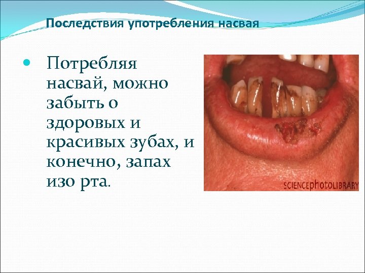 Последствия употребления насвая Потребляя насвай, можно забыть о здоровых и красивых зубах, и конечно,