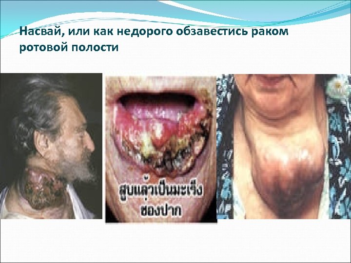 Насвай, или как недорого обзавестись раком ротовой полости 