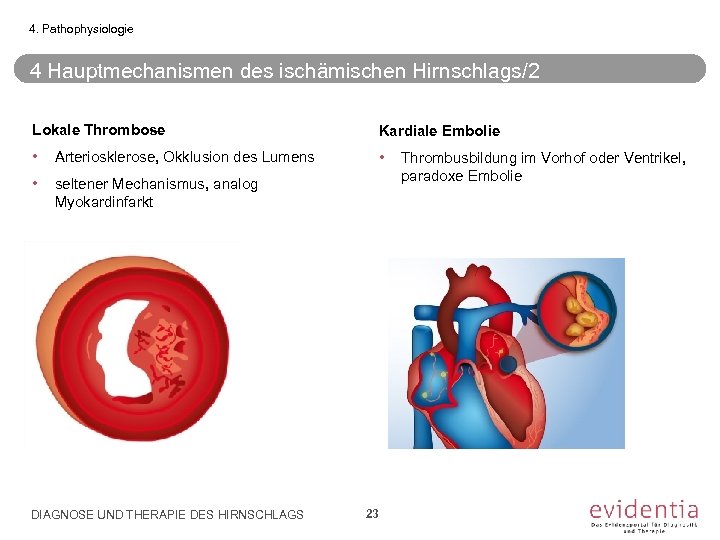 4. Pathophysiologie 4 Hauptmechanismen des ischämischen Hirnschlags/2 Lokale Thrombose Kardiale Embolie • Arteriosklerose, Okklusion