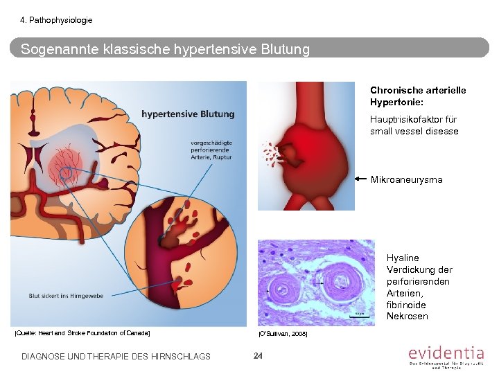4. Pathophysiologie Sogenannte klassische hypertensive Blutung Chronische arterielle Hypertonie: Hauptrisikofaktor für small vessel disease