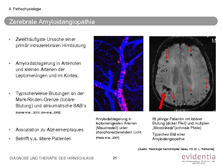 4. Pathophysiologie Zerebrale Amyloidangiopathie • Zweithäufigste Ursache einer primär intrazerebralen Hirnblutung • Amyloidablagerung in