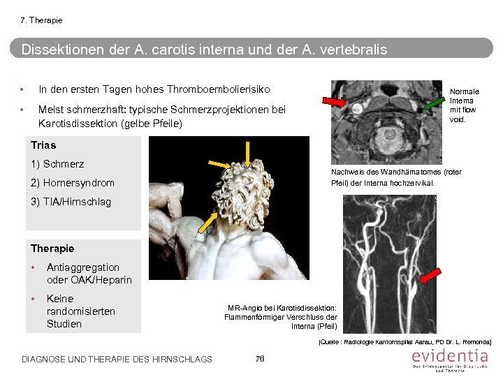 7. Therapie Dissektionen der A. carotis interna und der A. vertebralis • In den