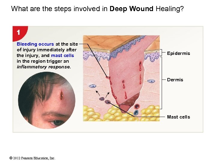 What are the steps involved in Deep Wound Healing? Bleeding occurs at the site