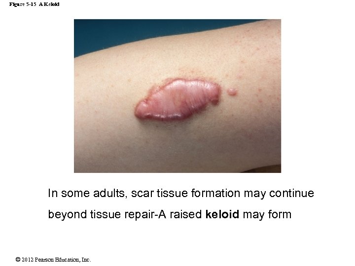 Figure 5 -15 A Keloid In some adults, scar tissue formation may continue beyond