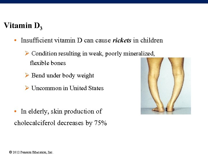 Vitamin D 3 • Insufficient vitamin D can cause rickets in children Ø Condition