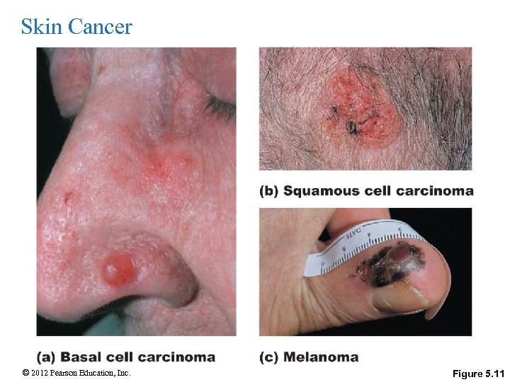 Skin Cancer © 2012 Pearson Education, Inc. Figure 5. 11 