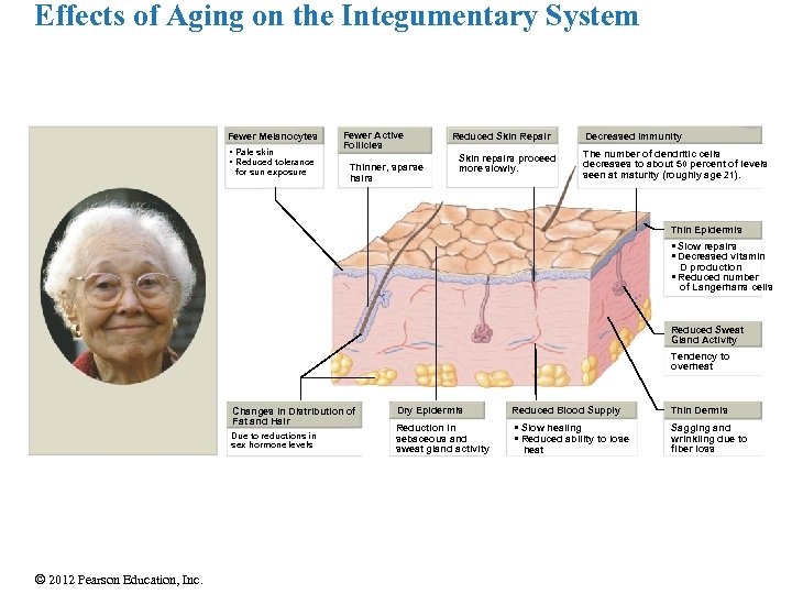 Effects of Aging on the Integumentary System Fewer Melanocytes • Pale skin • Reduced