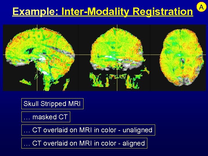 Example: Inter-Modality Registration Skull Stripped MRI … masked CT … CT overlaid on MRI