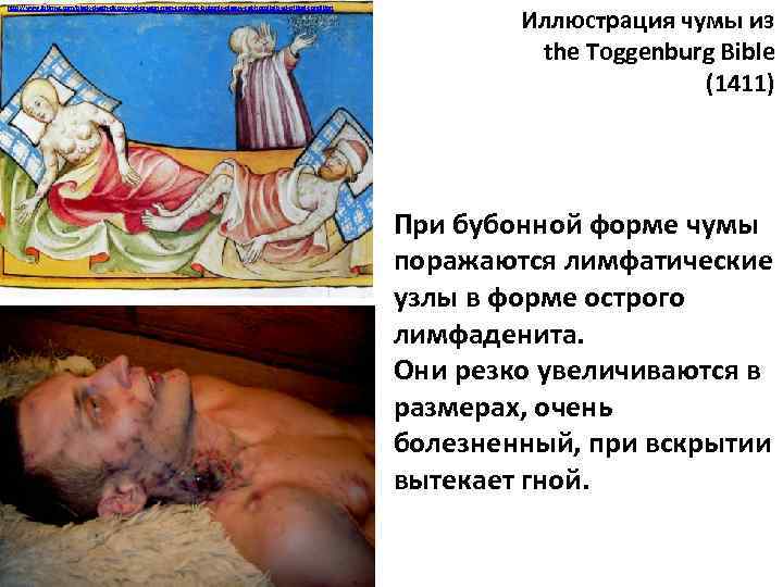 http: //www. ibtimes. com/black-death-discovered-oregon-man-contracts-bubonic-plague-cat-hospitalized-critical-condition Иллюстрация чумы из the Toggenburg Bible (1411) При бубонной форме